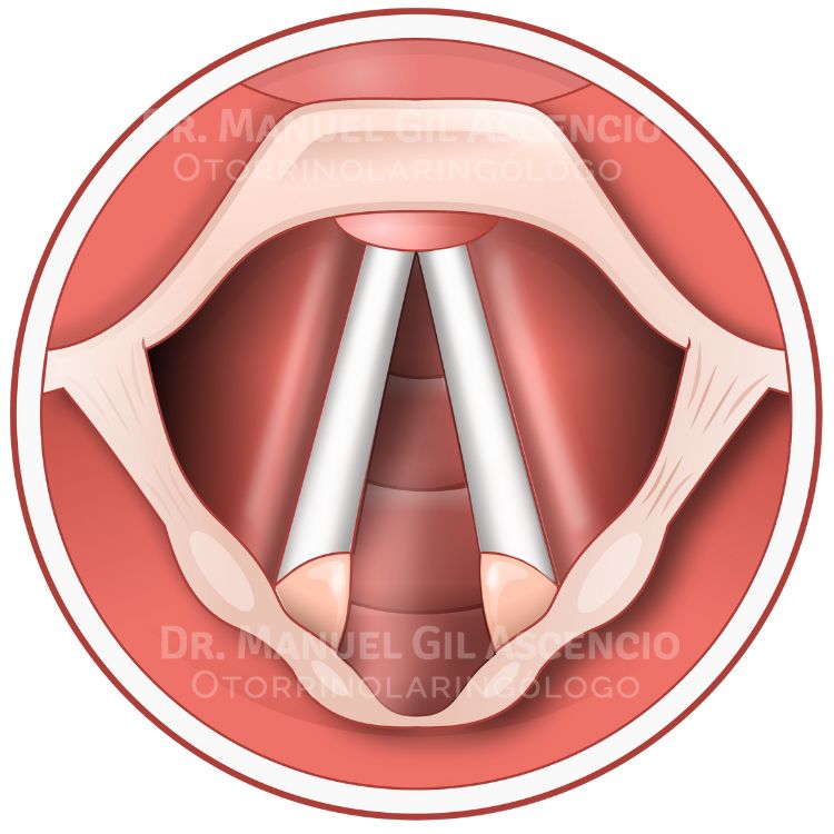  Cuerdas Vocales O Cuerdas Bucales Dr Manuel Gil